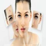 Get Rid of Acne  (Guide)1.1_rowtechapk.com