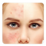 guide to Get rid of Acne1.1_rowtechapk.com